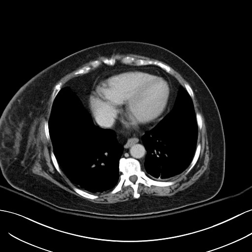 File:Breast carcinoma with pathological hip fracture (Radiopaedia 60314-67974 B 2).jpg