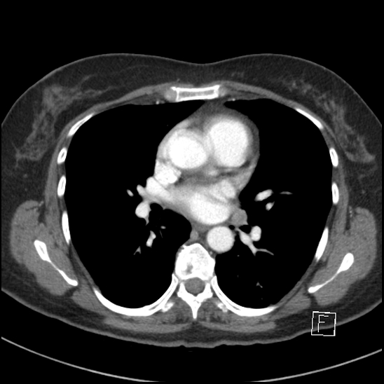 File:Breast metastases from renal cell cancer (Radiopaedia 79220-92225 A 48).jpg