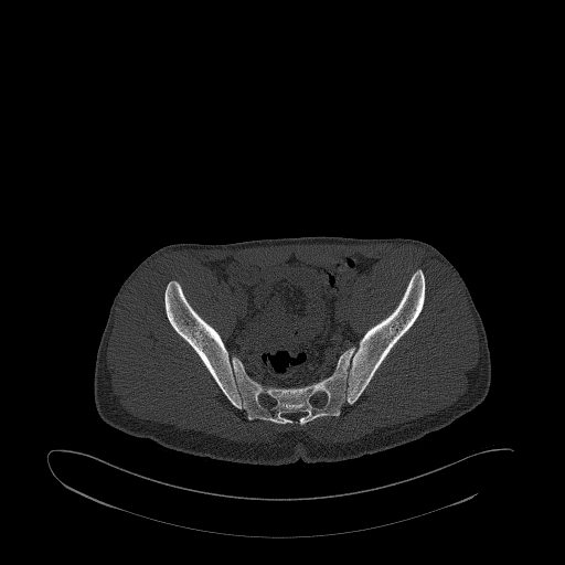 Brodie abscess- femoral neck (Radiopaedia 53862-59966 Axial bone window 80).jpg