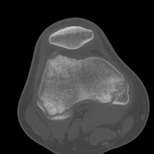 Brodie abscess of the tibia (Radiopaedia 58984-66250 Axial bone window 32).jpg