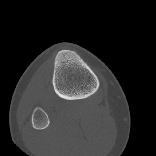 Brodie abscess of the tibia (Radiopaedia 58984-66250 Axial bone window 86).jpg