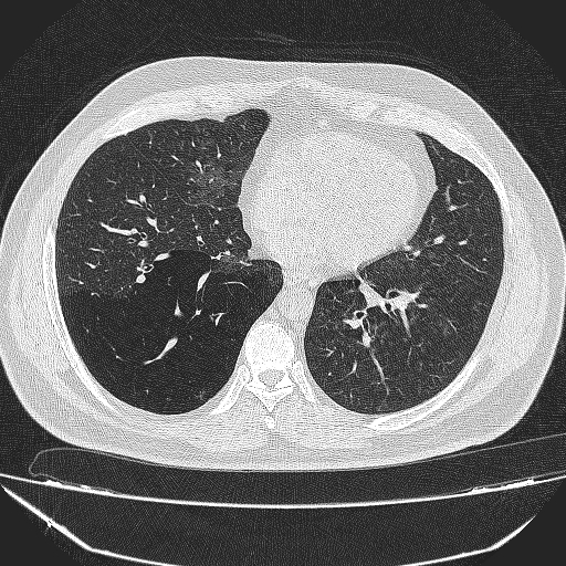 File:Bronchial atresia (Radiopaedia 58271-65417 Axial lung window 31).jpg