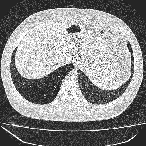 File:Bronchial atresia (Radiopaedia 58271-65417 Axial lung window 43).jpg