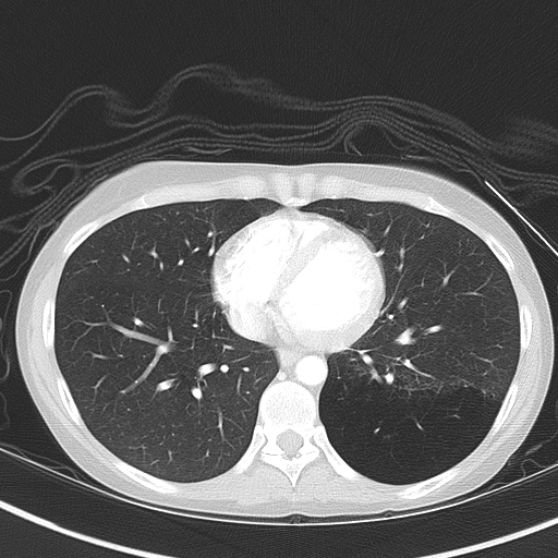 File:Bronchial atresia (Radiopaedia 73677-84470 Axial lung window 41).jpg