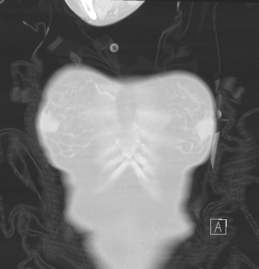 File:Bronchial atresia (Radiopaedia 73677-84470 Coronal lung window 1).jpg