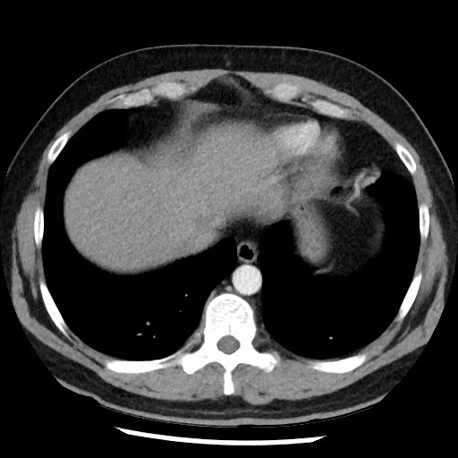 File:Bronchial carcinoid tumor (Radiopaedia 67377-76764 A 49).jpg