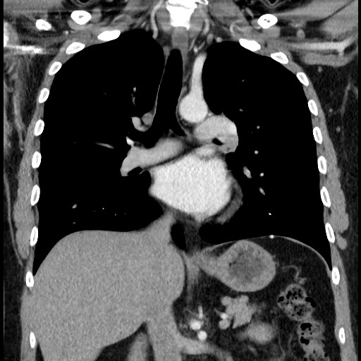 File:Bronchial carcinoid tumor (Radiopaedia 67377-76764 C 37).jpg