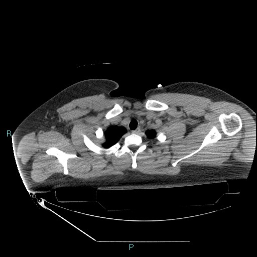 Bronchial carcinoid tumor (Radiopaedia 78272-90870 Axial non-contrast 11).jpg
