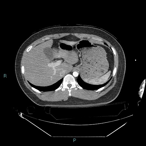 Bronchial carcinoid tumor (Radiopaedia 78272-90870 B 113).jpg