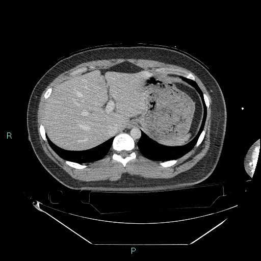 Bronchial carcinoid tumor (Radiopaedia 78272-90870 C 109).jpg