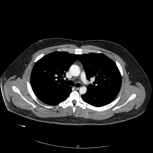 Bronchial carcinoid tumor (Radiopaedia 78272-90875 A 41).jpg