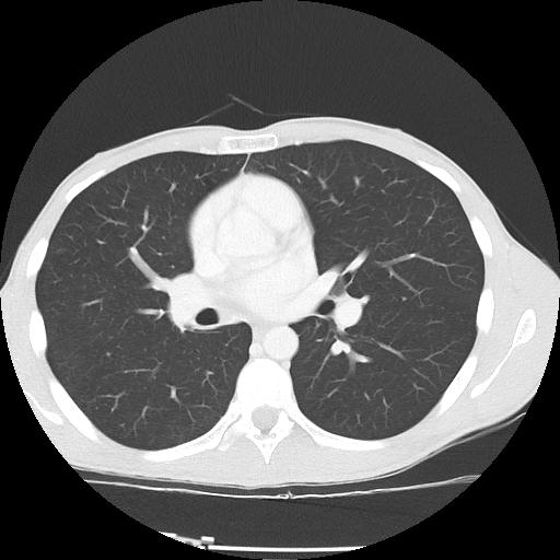 Bronchial carcinoid tumor causing right lower lobe collapse (Radiopaedia 83495-98594 Axial lung window 25).jpg