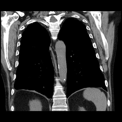 Bronchial stenosis - lung transplant (Radiopaedia 73133-83848 Coronal non-contrast 45).jpg