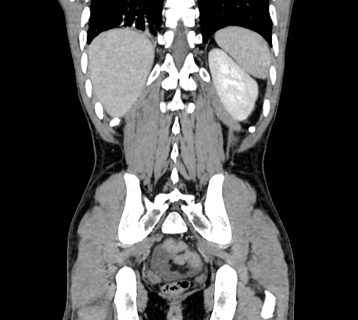 File:Bronchiectasis in Crohn disease (Radiopaedia 60311-67977 C 68).jpg