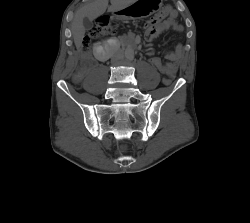 Bronchiectasis in Crohn disease (Radiopaedia 60311-67977 Coronal bone window 30).jpg