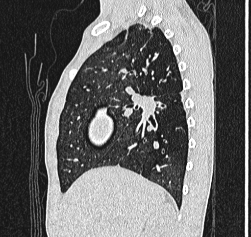 Bronchiolitis obliterans (Radiopaedia 71538-81897 Sagittal lung window 21).jpg