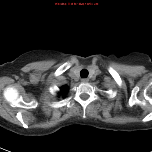 File:Bronchoalveolar carcinoma (BAC) (Radiopaedia 13436-13392 Axial non-contrast 3).jpg
