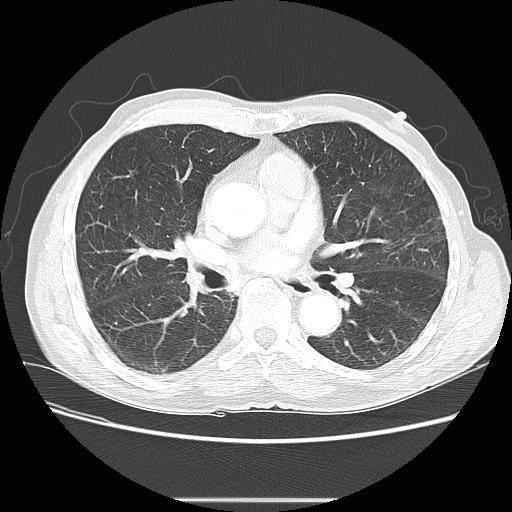 Bronchocele (Radiopaedia 17097-16795 Axial lung window 62).jpg