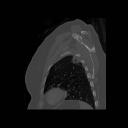 Bronchogenic carcinoma (Radiopaedia 73497-84262 Sagittal bone window 126).jpg