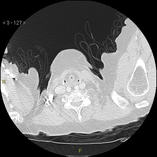 Bronchogenic carcinoma as an incidental finding (Radiopaedia 16453-16130 Axial lung window 127).jpg