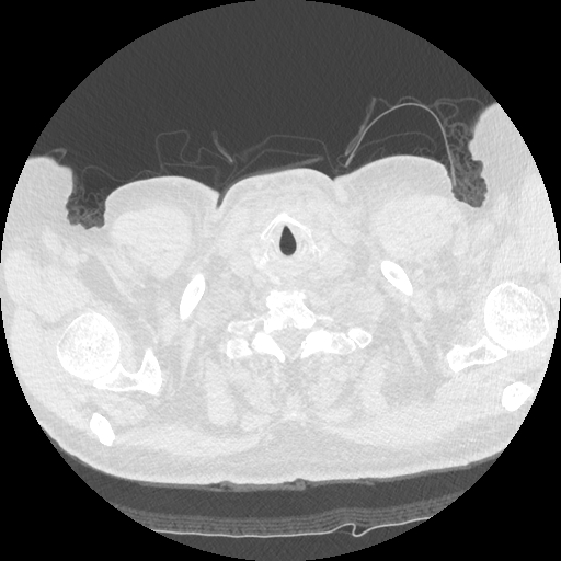 Bronchogenic carcinoma with metastatic lymphadenopathy (Radiopaedia 37671-39569 Axial lung window 1).jpg