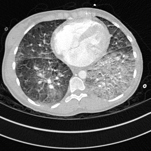 File:Bronchogenic cyst (Radiopaedia 77801-90071 Axial lung window 57).jpg