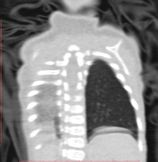 Bronchogenic cyst (Radiopaedia 78599-91409 Coronal lung window 186).jpg