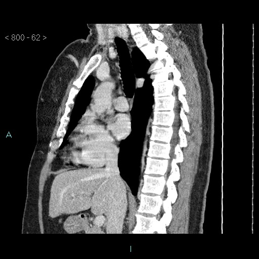 Bronchogenic cyst - posterior mediastinal (Radiopaedia 43885-47364 B 41).jpg