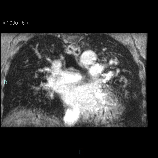 File:Bronchogenic cyst - posterior mediastinal (Radiopaedia 43885-47365 Coronal T1 C+ 4).jpg