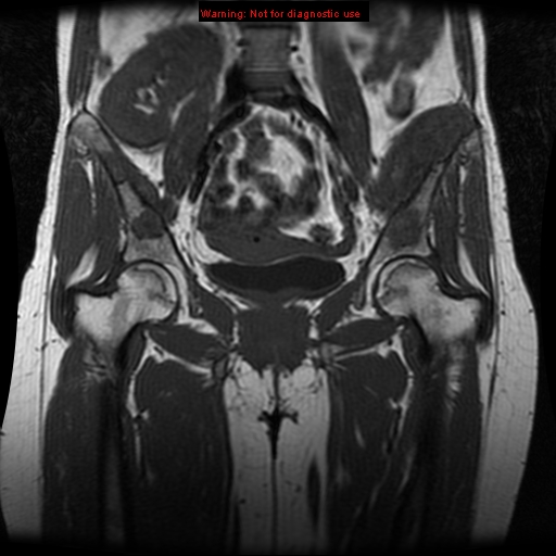 File:Brown tumors (Radiopaedia 9666-10290 Coronal T1 12).jpg