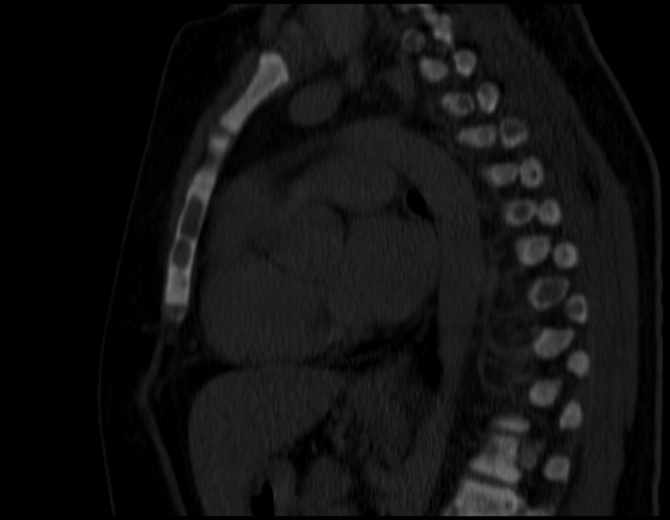 Brown tumors compressing the spinal cord (Radiopaedia 68442-77988 Sagittal bone window 33).jpg