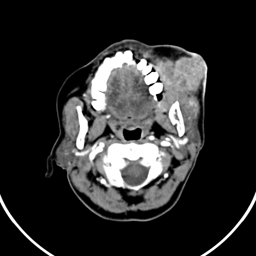 File:Buccal squamous cell carcinoma (Radiopaedia 8520-9346 A 15).jpg