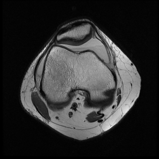 File:Bucket handle meniscus tear (Radiopaedia 56916-63751 Axial PD 6).jpg