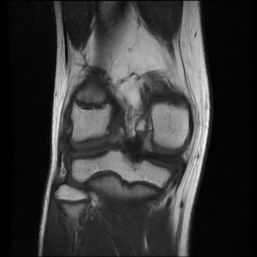 File:Bucket handle tear - lateral meniscus (Radiopaedia 72124-82634 Coronal T1 12).jpg