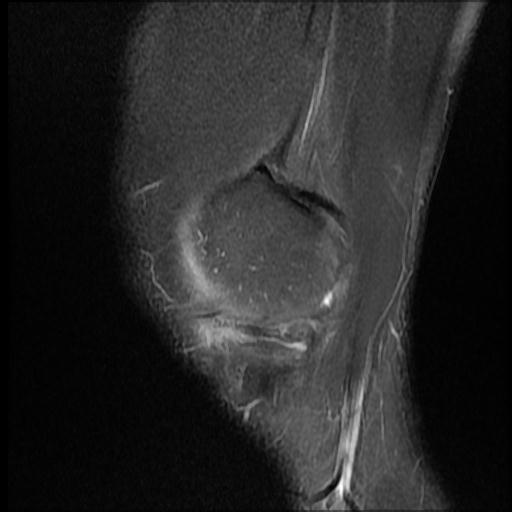 File:Bucket handle tear - medial meniscus (Radiopaedia 69245-79026 Sagittal PD fat sat 16).jpg
