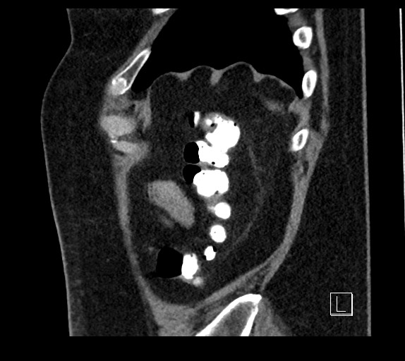 Buried bumper syndrome - gastrostomy tube (Radiopaedia 63843-72577 Sagittal Inject 14).jpg