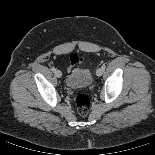 Burned-out testicular seminoma - retroperitoneal nodal metastases (Radiopaedia 62872-71245 A 64).jpg