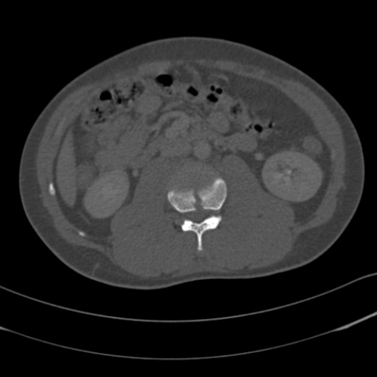 Burst fracture with cauda equina syndrome (Radiopaedia 25701-25867 Axial bone window 59).jpg