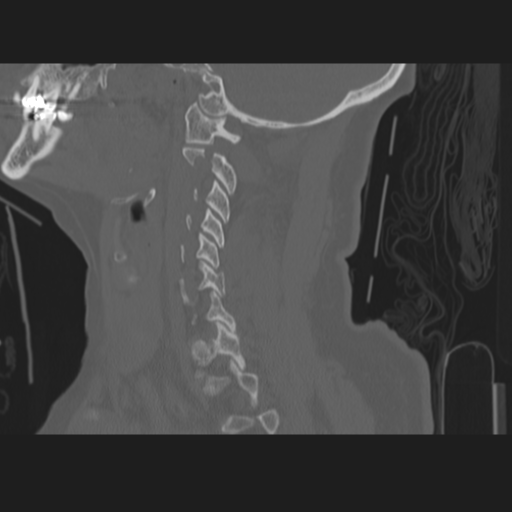 File:C2 fracture (Radiopaedia 34091-35341 Sagittal bone window 26).png