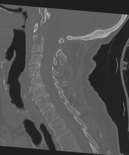 C2 fracture with vertebral artery dissection (Radiopaedia 37378-39199 Sagittal bone window 36).png