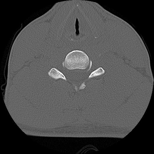 File:C5 facet fracture (Radiopaedia 58374-65499 Axial bone window 57).jpg