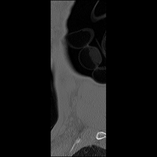 C5 facet fracture (Radiopaedia 58374-65499 Sagittal bone window 4).jpg
