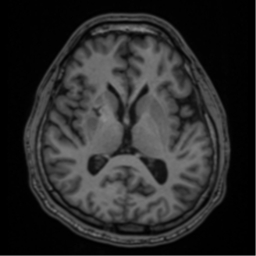 CNS vasculitis (Radiopaedia 55715-62263 Axial T1 33).png