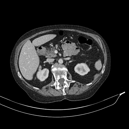 Calcified adrenal glands and Spigelian hernia (Radiopaedia 49741-54988 A 74).jpg