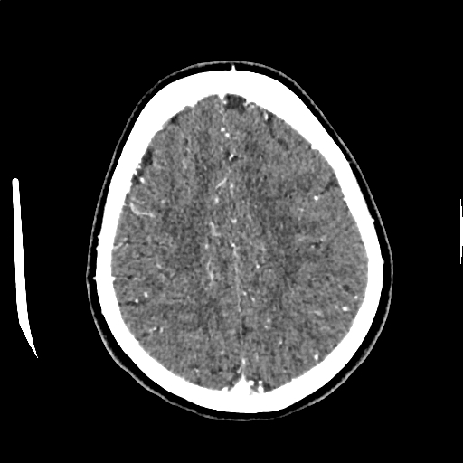 Calcified cerebral hydatid cyst (Radiopaedia 65603-74717 Axial with contrast 59).jpg