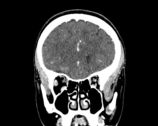 Calcified cerebral hydatid cyst (Radiopaedia 65603-74717 C 17).jpg
