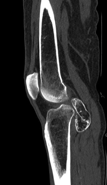 Calcified hematoma - popliteal fossa (Radiopaedia 63938-72763 Sagittal bone window 64).jpg