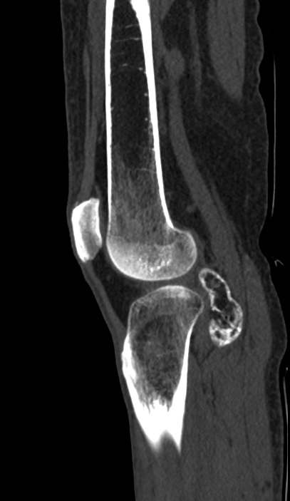 Calcified hematoma - popliteal fossa (Radiopaedia 63938-72763 Sagittal bone window 79).jpg