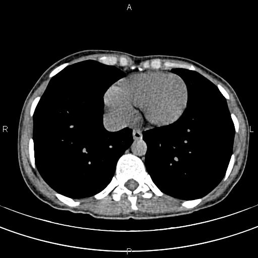 File:Calcified hepatic hydatid cyst (Radiopaedia 83870-99072 Axial non-contrast 2).jpg