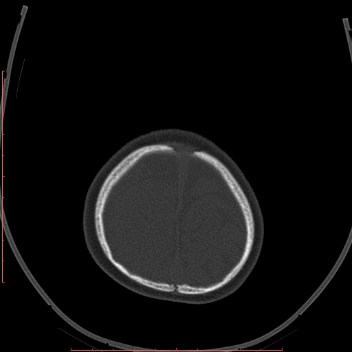 Calcified middle cerebral artery embolism (Radiopaedia 78949-91860 Axial bone window 65).jpg